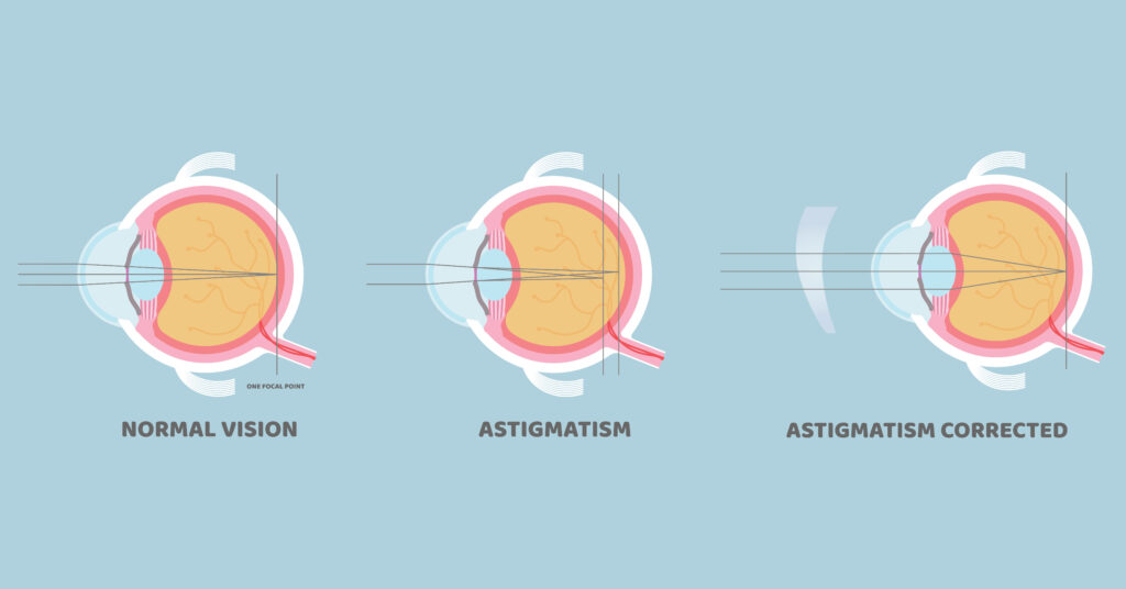 Astigmatism