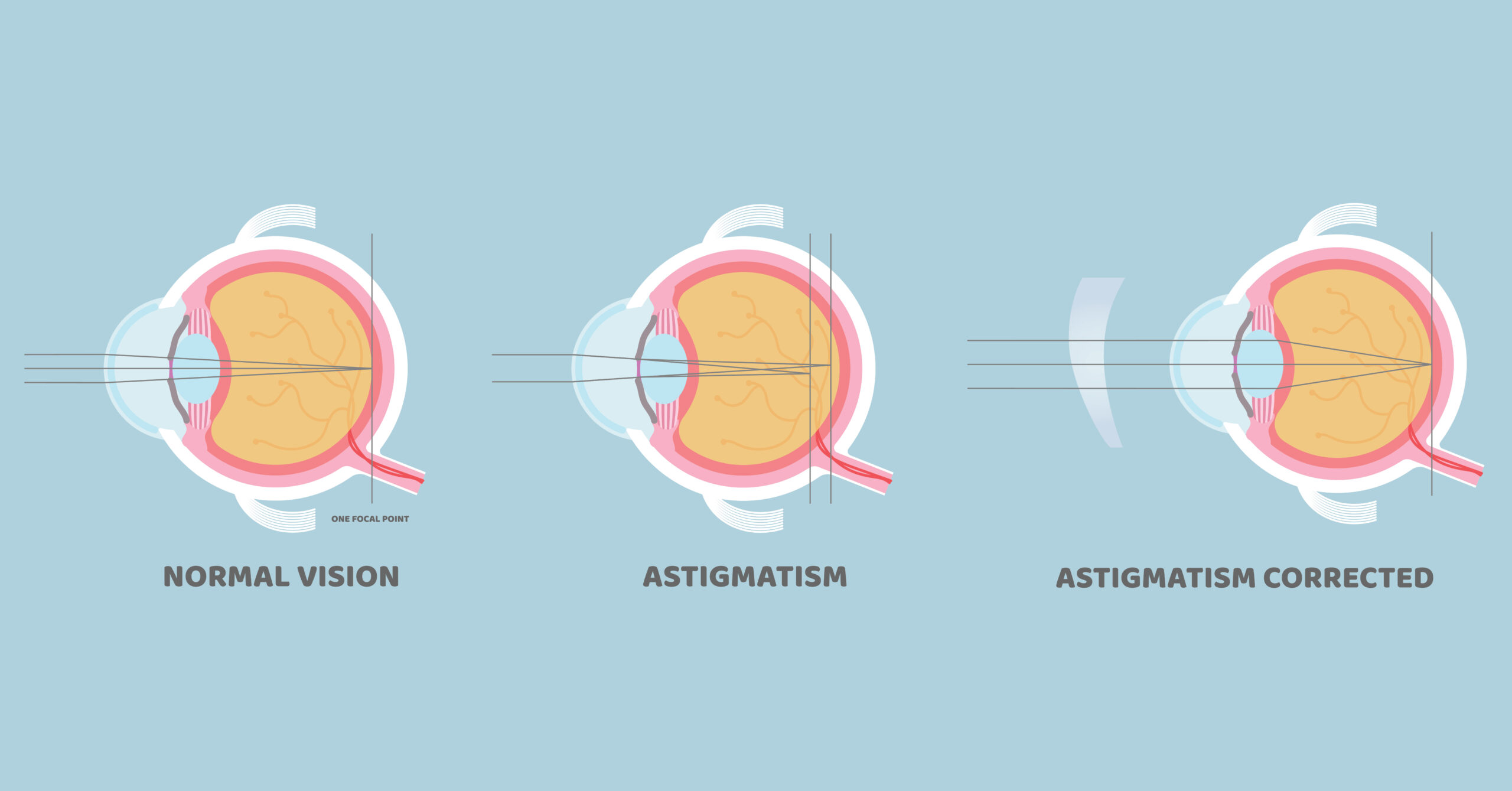 Astigmatism