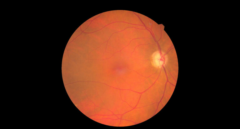 Fundus Eye Rd Fundus: Understanding Its Role in Maintaining Eye Health
