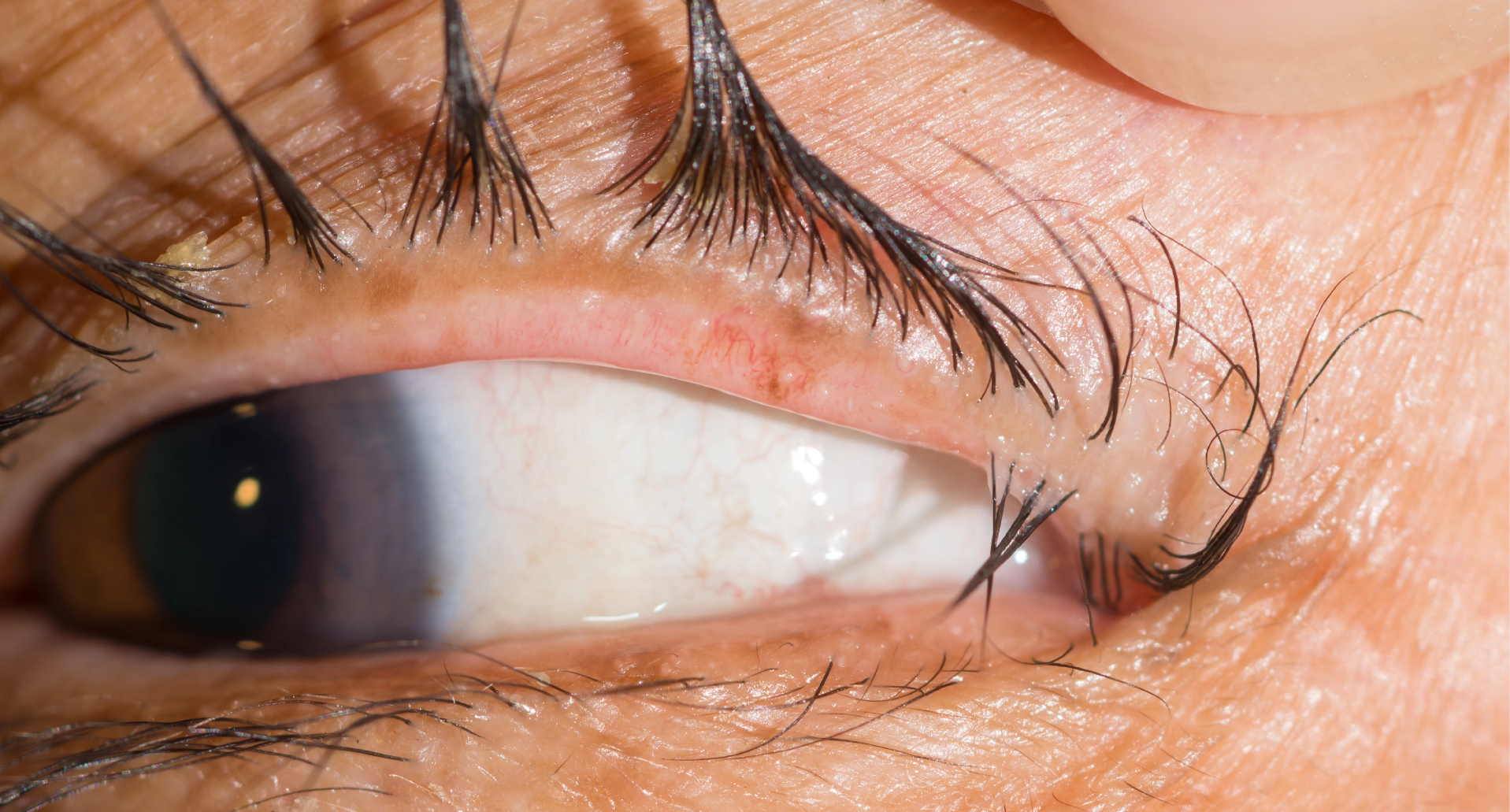 Trichiasis