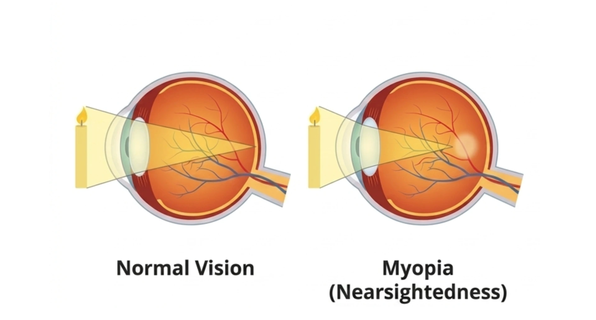 Myopia